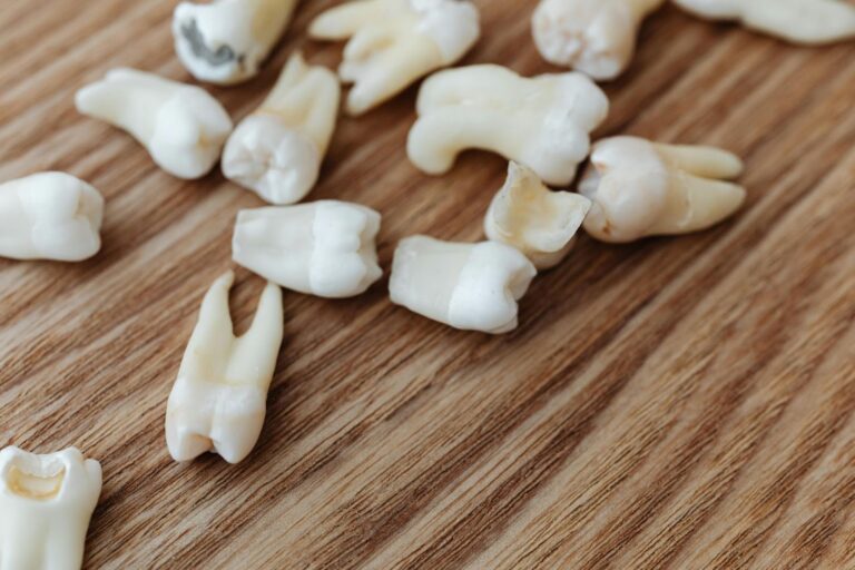Dentes do siso: Quando e porquê devo removê-los?