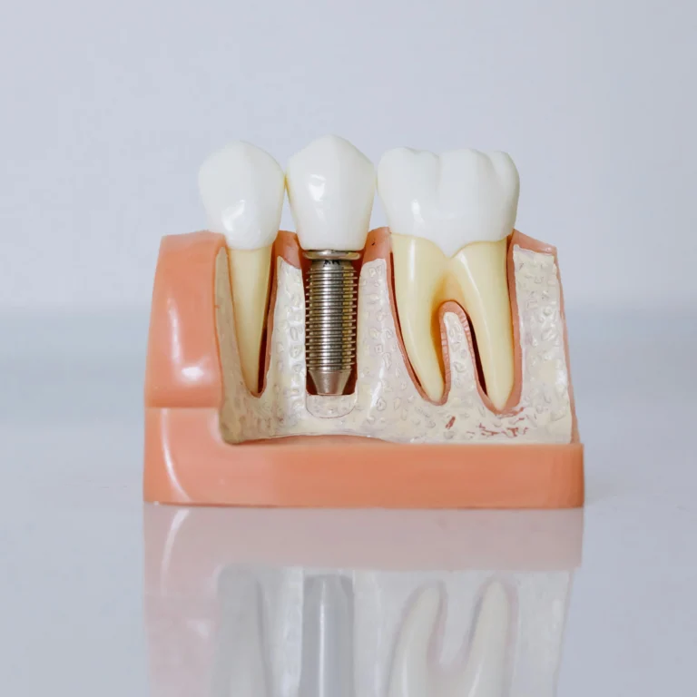 Desmistificando a cirurgia de implantes dentários
